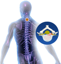 Cervical Herniated Disc