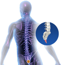 Coccygectomy