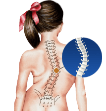 Congenital Scoliosis