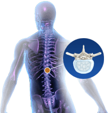 Thoracic Spinal Stenosis